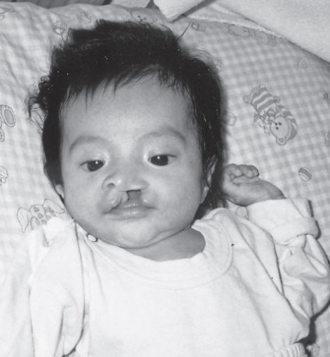 diana-cleft-lip-and-palate