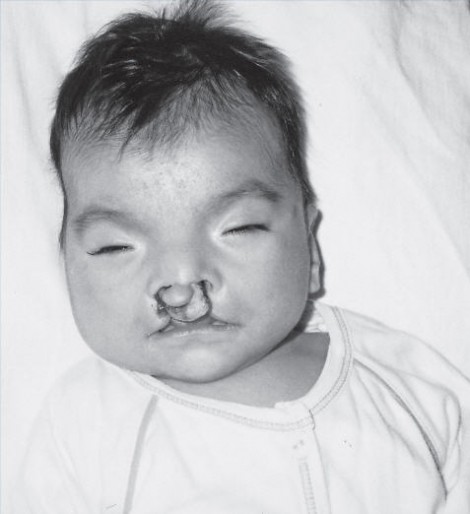 orlando-cleft-lip-and-palate