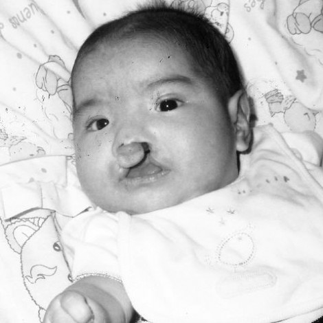 Estrella - Cleft Lip and Palate