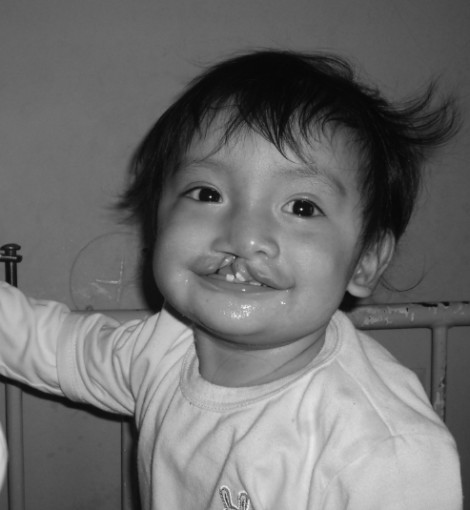 Fatima - Cleft lip and Palate