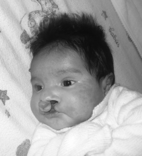 Juan José - Cleft Lip and Palate